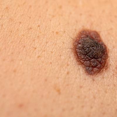 Skin Check Photography Thumbnail